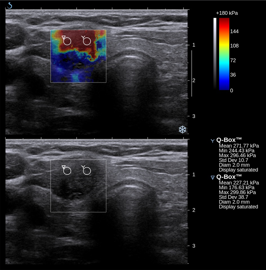 Ultrasound elastography